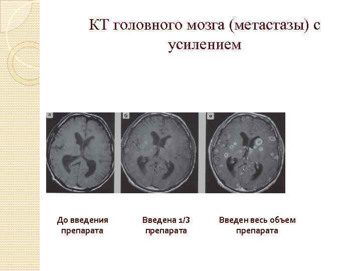 КТ головного мозга (метастазы) с усилением До введения препарата Введена 1/3 препарата Введен весь