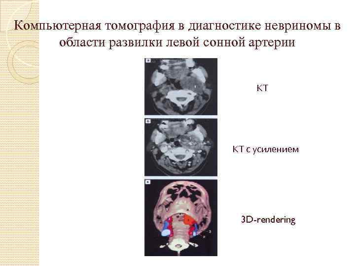 Компьютерная томография в диагностике невриномы в области развилки левой сонной артерии КТ КТ с