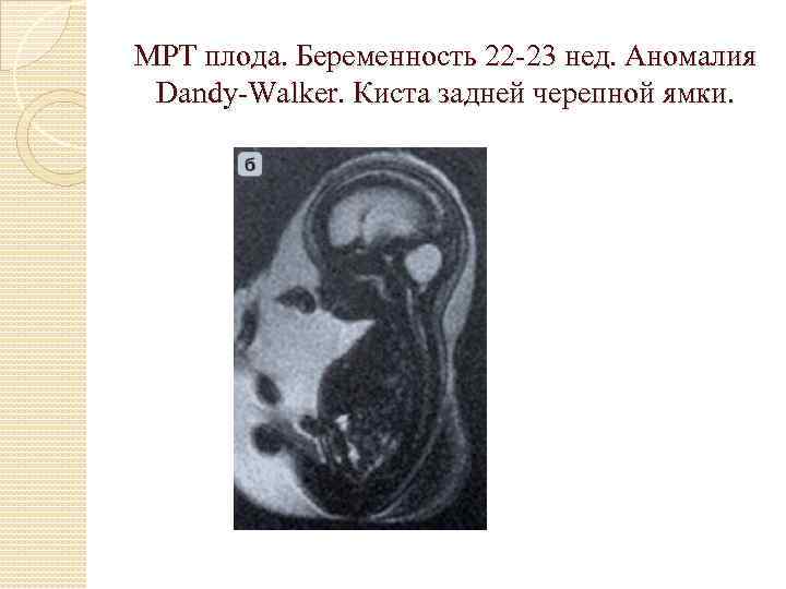 МРТ плода. Беременность 22 -23 нед. Аномалия Dandy-Walker. Киста задней черепной ямки. 