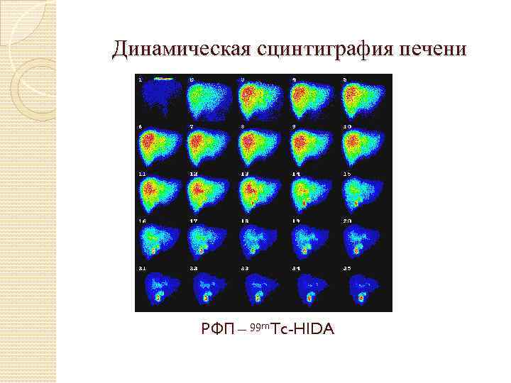 Динамическая сцинтиграфия печени РФП – 99 m. Tc-HIDA 