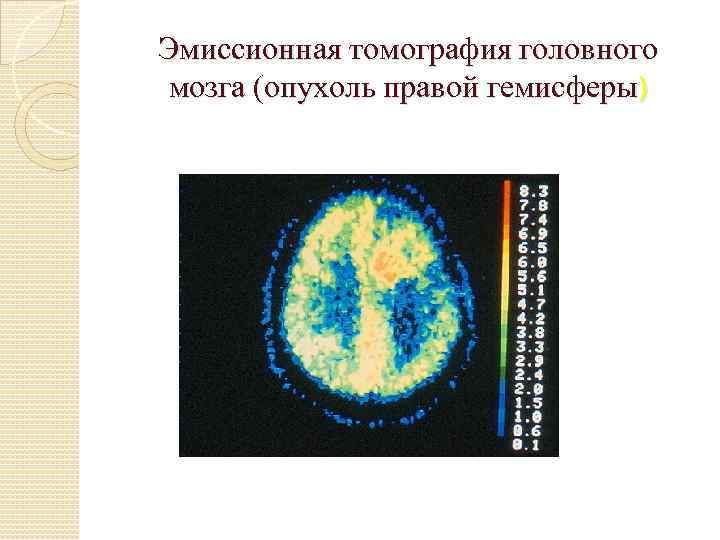 Эмиссионная томография головного мозга (опухоль правой гемисферы) 