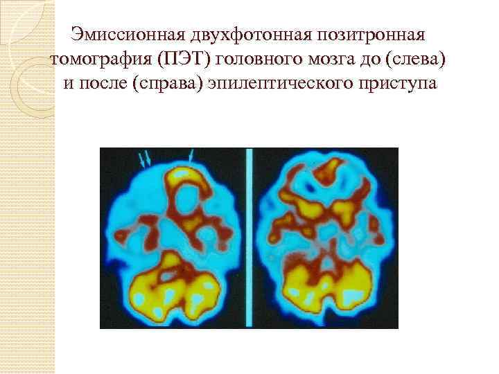 Эмиссионная двухфотонная позитронная томография (ПЭТ) головного мозга до (слева) и после (справа) эпилептического приступа