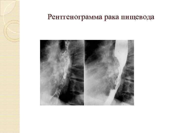 Рентгенологическая картина рака пищевода экзофитный эндофитный