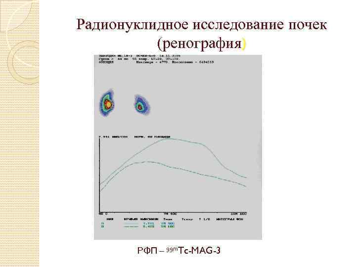 Радионуклидное исследование почек (ренография) РФП – 99 m. Tc-MAG-3 