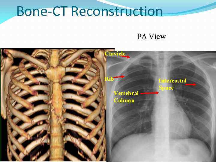 Bone-CT Reconstruction PA View Clavicle Rib Vertebral Column Intercostal Space 