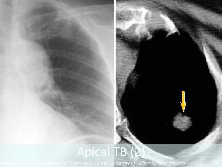 Apical TB (2) Image credit: Curry International Tuberculosis Center, University of California, San Francisco