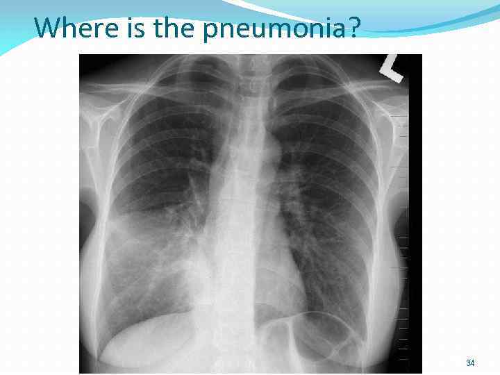 Where is the pneumonia? 154 slides 34 34 