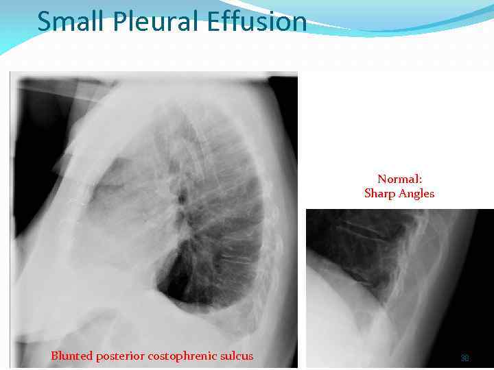 Small Pleural Effusion Normal: Sharp Angles 154 slides Blunted posterior costophrenic sulcus 38 38