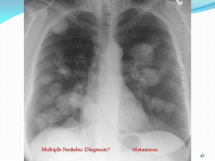 Multiple Nodules: Diagnosis? 154 slides Metastases 42 42 