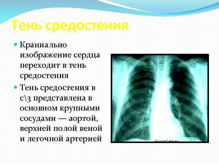 Лучевая диагностика органов средостения презентация