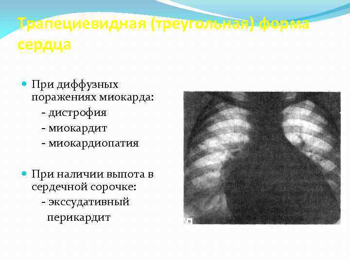 Трапециевидная (треугольная) форма сердца При диффузных поражениях миокарда: - дистрофия - миокардит - миокардиопатия