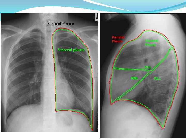 Parietal Pleura Visceral pleura 