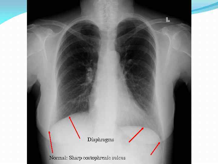 Diaphragms Normal: Sharp costophrenic sulcus 