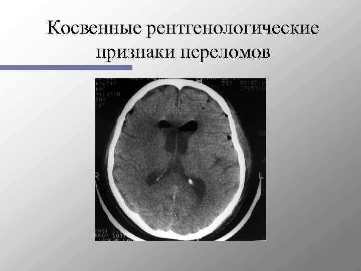 Косвенные рентгенологические признаки перелома. Косвенные рентгенологические признаки перелома костей. Рентгенологические методы диагностики ЧМТ.