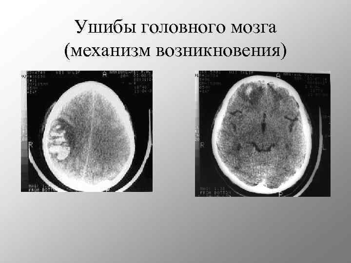 Повреждения головного мозга возникают