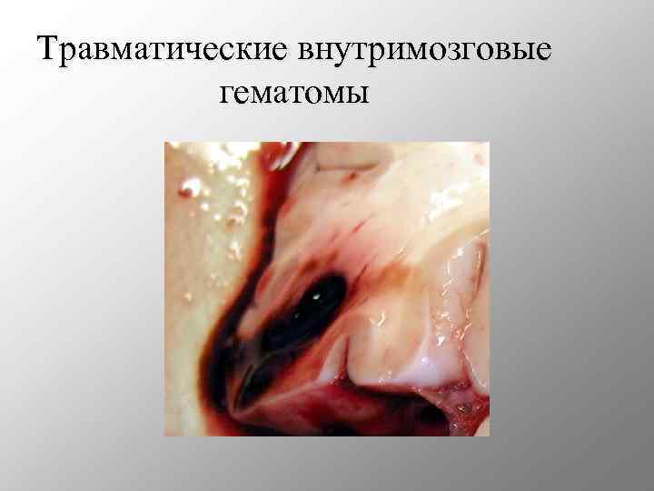 Травматические внутримозговые гематомы 