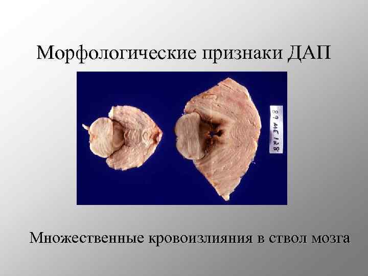 Морфологические признаки ДАП Множественные кровоизлияния в ствол мозга 
