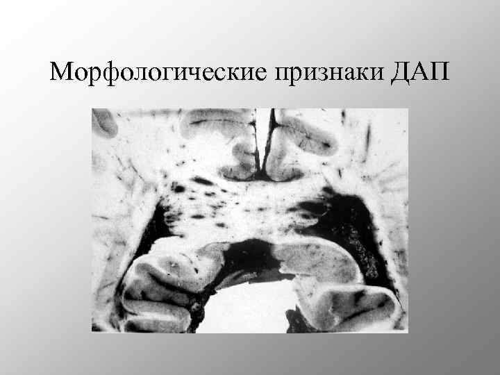 Морфологические признаки ДАП 