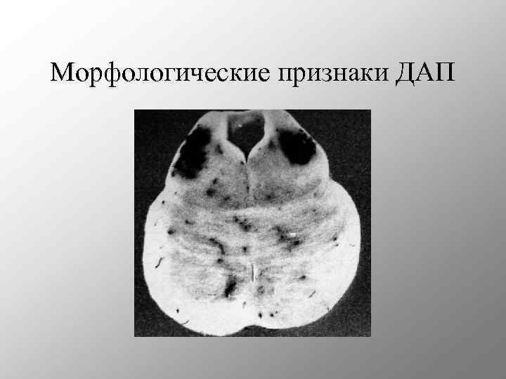 Морфологические признаки ДАП 