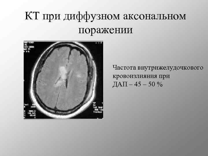 КТ при диффузном аксональном поражении Частота внутрижелудочкового кровоизлияния при ДАП – 45 – 50