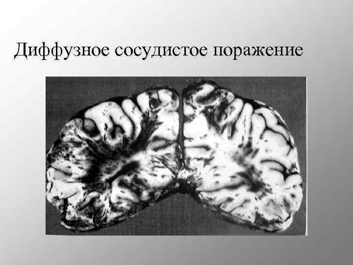 Диффузное сосудистое поражение 