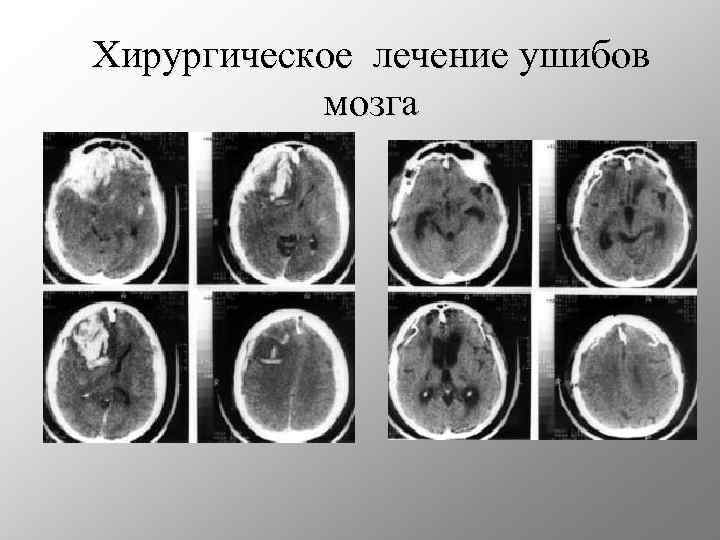 Хирургическое лечение ушибов мозга 