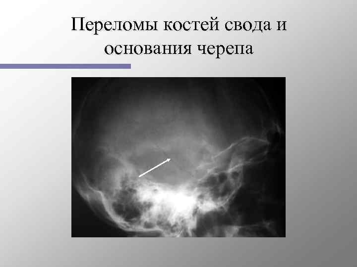 Линейная трещина. Перелом свода основания черепа. Перелом костей свода черепа. Клиническая картина перелом свода черепа.