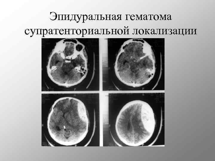 Эпидуральная гематома супратенториальной локализации 
