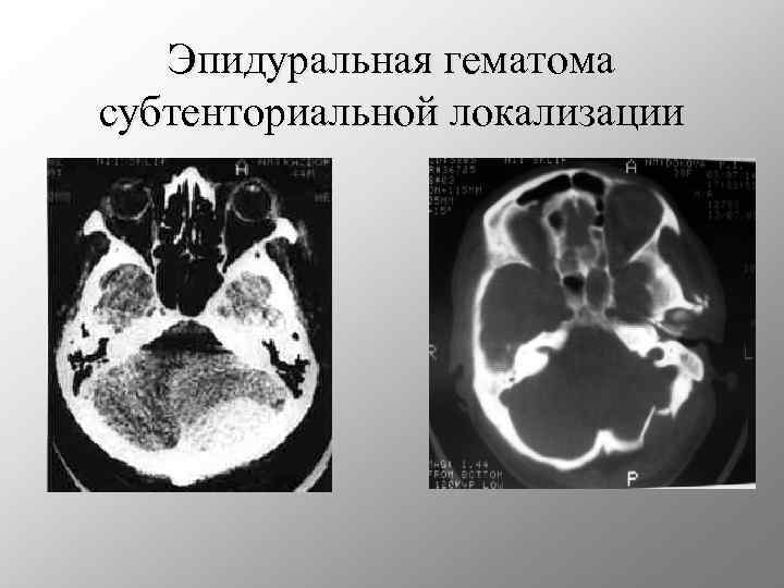 Эпидуральная гематома субтенториальной локализации 