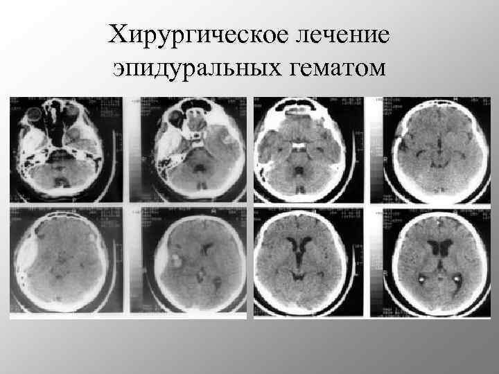 Хирургическое лечение эпидуральных гематом 
