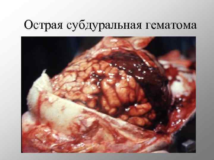 Острая субдуральная гематома 