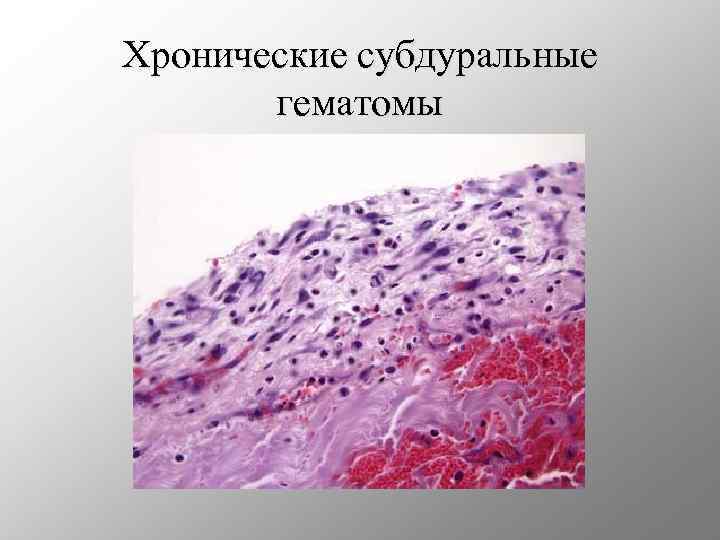 Хронические субдуральные гематомы 