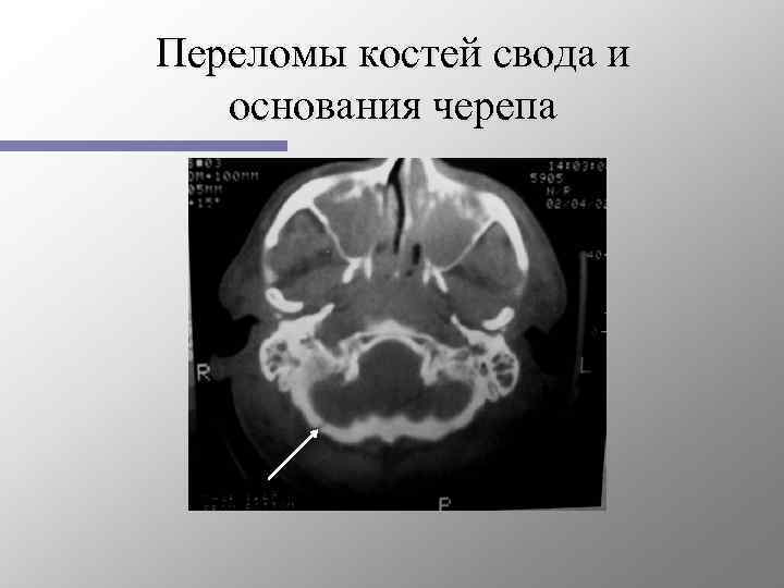 Перелом основания свода. Перелом свода черепа, перелом основания черепа. Перелом основания черепа неврология. Перелом основания черепа на кт. Перелом свода основания черепа.