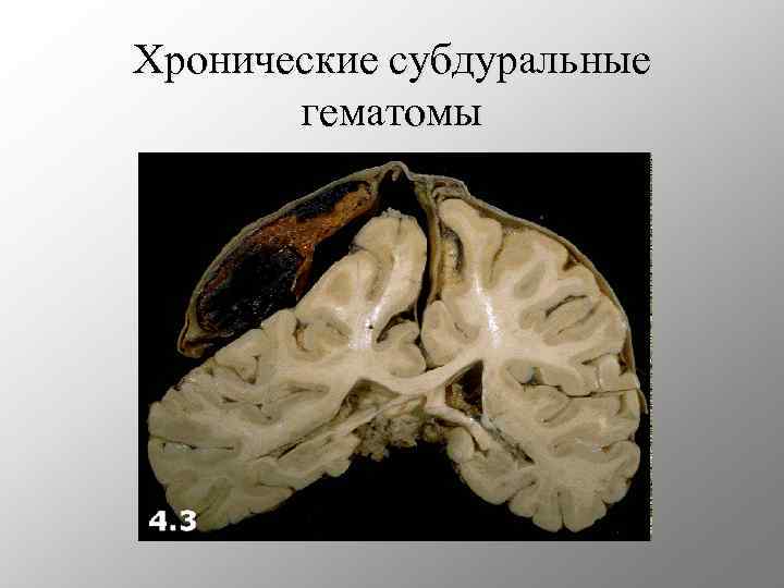 Хронические субдуральные гематомы 