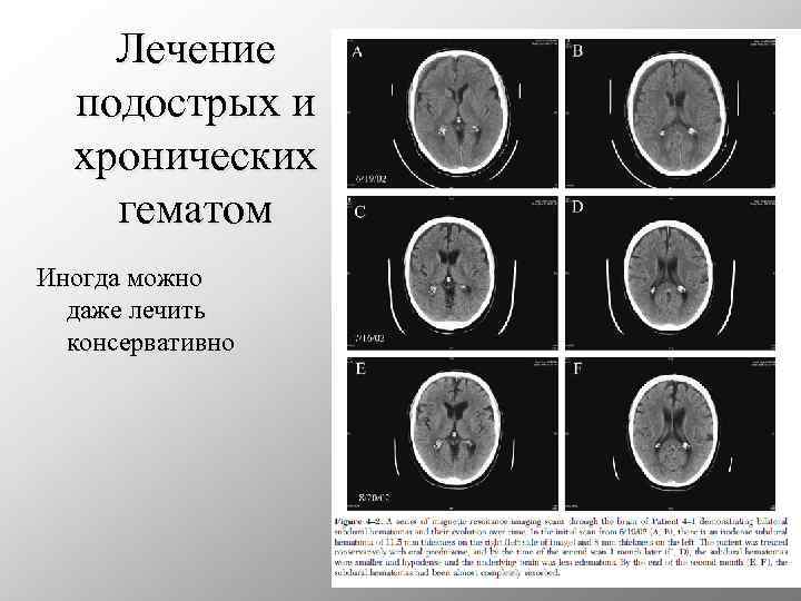 Лечение подострых и хронических гематом Иногда можно даже лечить консервативно 