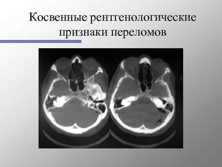 Косвенные рентгенологические признаки переломов 
