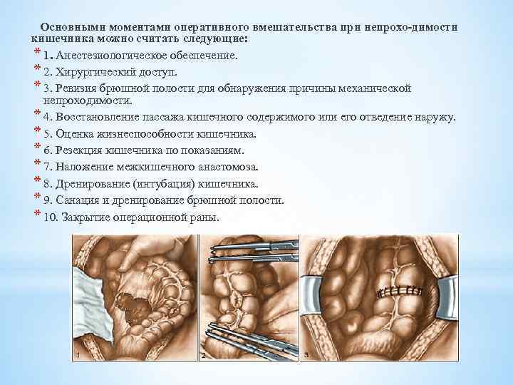  Основными моментами оперативного вмешательства при непрохо димости кишечника можно считать следующие: * 1.