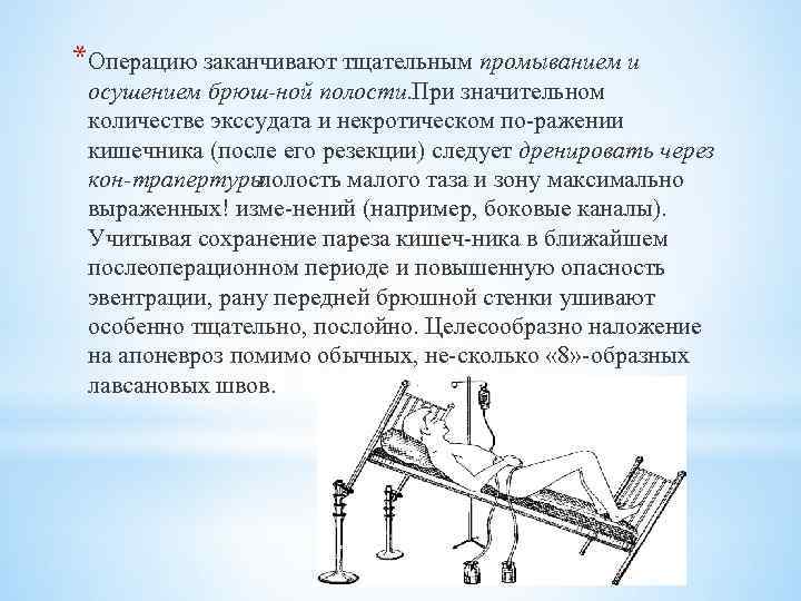 *Операцию заканчивают тщательным промыванием и осушением брюш ной полости. ри значительном П количестве экссудата