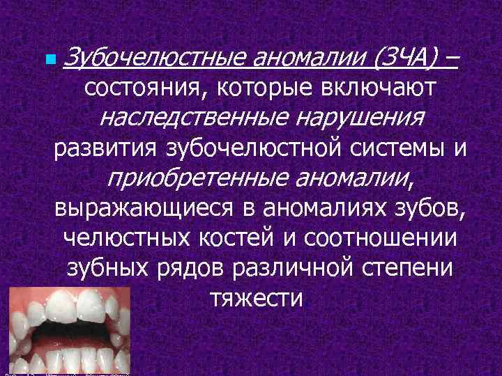 n Зубочелюстные аномалии (ЗЧА) – состояния, которые включают наследственные нарушения развития зубочелюстной системы и