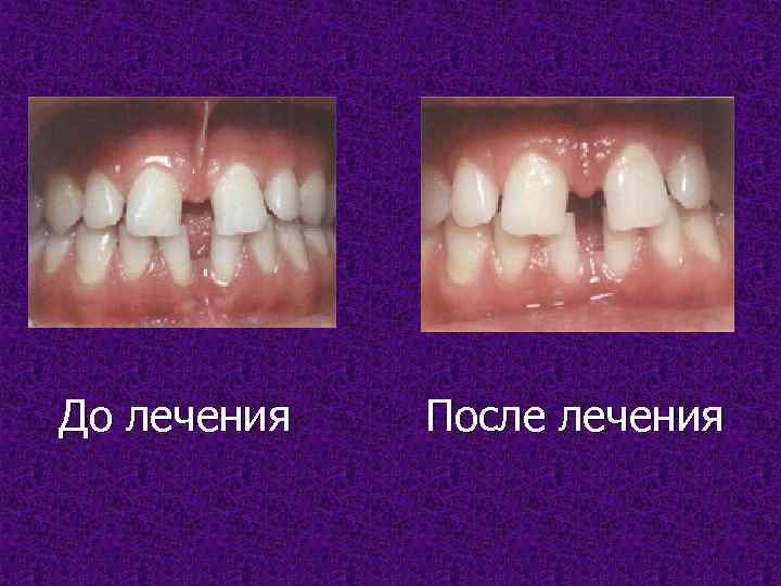 До лечения После лечения 