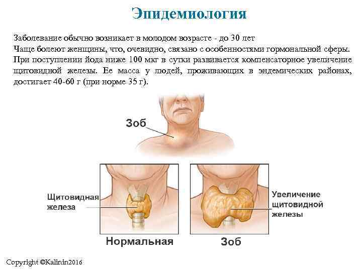 Эпидемиология Заболевание обычно возникает в молодом возрасте - до 30 лет Чаще болеют женщины,