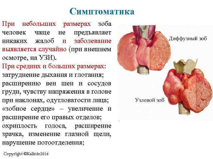 Симптоматика При небольших размерах зоба человек чаще не предъявляет никаких жалоб и заболевание выявляется