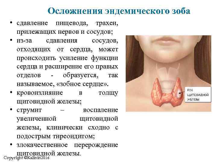 Осложнения эндемического зоба • сдавление пищевода, трахеи, прилежащих нервов и сосудов; • из-за сдавления