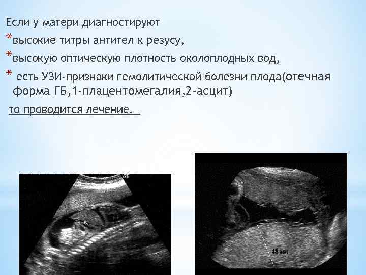 Если у матери диагностируют *высокие титры антител к резусу, *высокую оптическую плотность околоплодных вод,