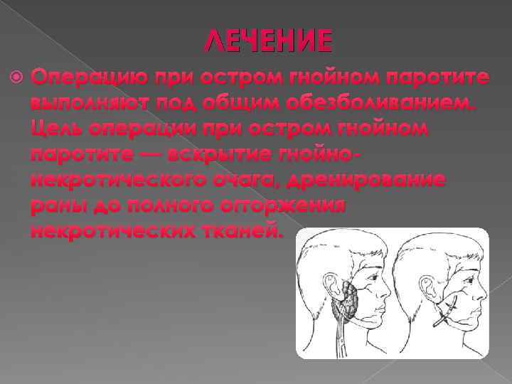 ЛЕЧЕНИЕ Операцию при остром гнойном паротите выполняют под общим обезболиванием. Цель операции при остром