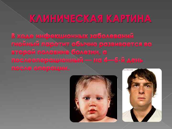 КЛИНИЧЕСКАЯ КАРТИНА В ходе инфекционных заболеваний гнойный паротит обычно развивается во второй половине болезни,