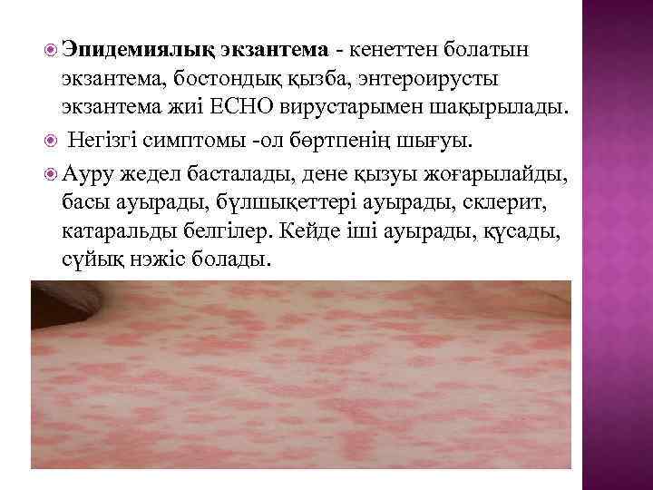  Эпидемиялық экзантема - кенеттен болатын экзантема, бостондық қызба, энтероирусты экзантема жиі ECHO вирустарымен
