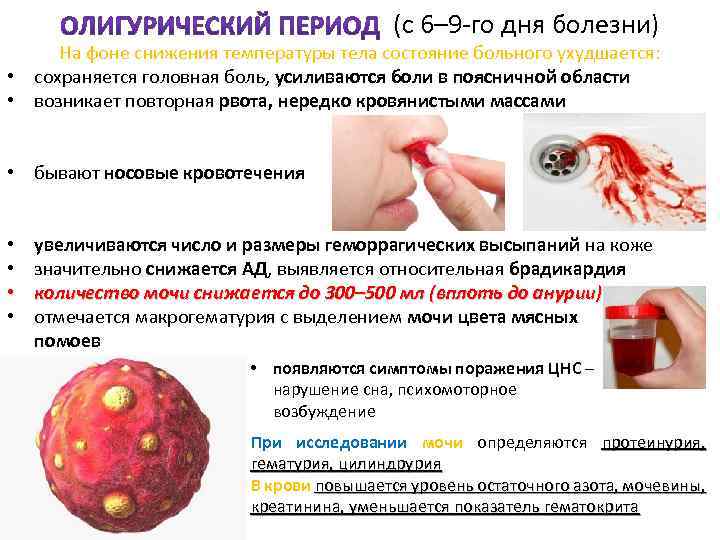 (с 6– 9 го дня болезни) На фоне снижения температуры тела состояние больного ухудшается: