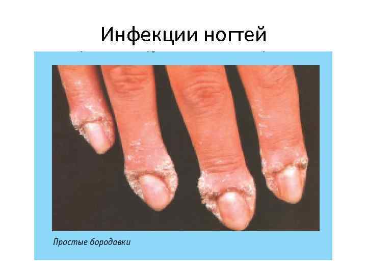 Инфекции ногтей 