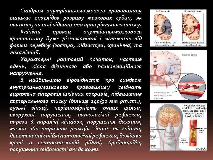 Синдром внутрішньомозкового крововиливу виникає внаслідок розриву мозкових судин, як правило, на тлі підвищення артеріального